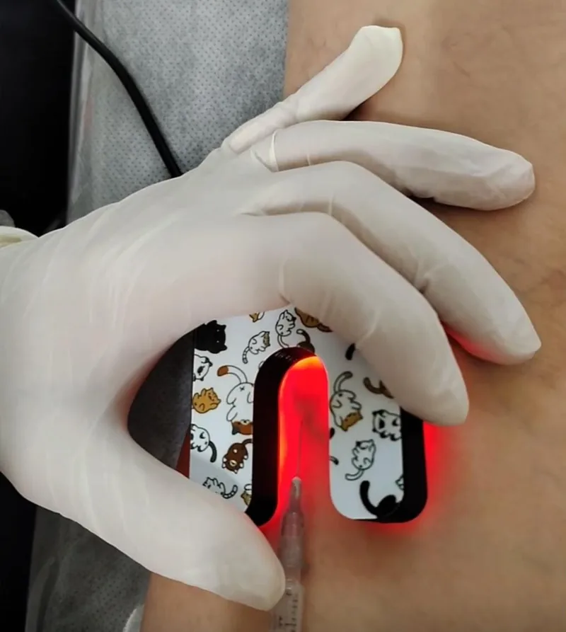 Busca venas MedMaker apoyado sobre el antebrazo: la vena se ve iluminada en rojo dentro del hueco de la U mientras una aguja entra por el centro